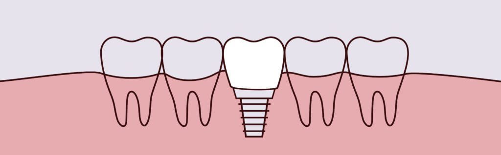 Dental Implants - Midtown General and Cosmetic Dentistry in Charlotte NC