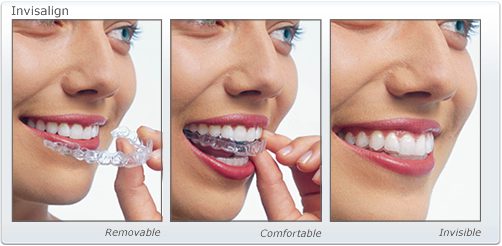 Invisalign Clear Aligners Image Midtown General & Cosmetic Dentistry in Charlotte NC
