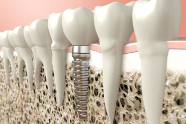 How Bone Grafts Protect Jaw Health And Expand Tooth Replacement Options