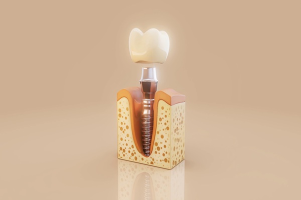 Top Benefits Of Choosing Dental Implants For Missing Teeth