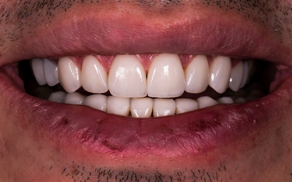 Questions To Ask Before Getting Dental Veneers